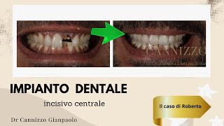 Impianto dentale su incisivo [upl. by Arleen]