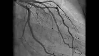 Coronary Angiography  NEJM [upl. by Kokoruda]