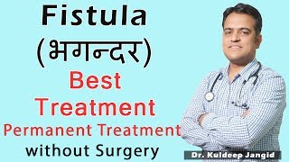 Best treatment of Fistula भगन्दर without operation  Fistula का 100 इलाज [upl. by Kwabena]