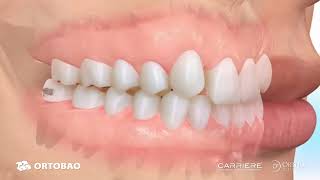 Ortobao Carriere® Clear Motion™ Class II Appliance Maxillary hypoplasia ORTOHERO [upl. by Buskirk]