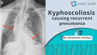 Kyphoscoliosis causing recurrent pneumonia [upl. by Cash]