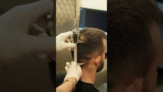 HAIR TRANPLANT TURKEY  MEDART HAIR ISTANBUL  hairtransplantbeforeafter [upl. by Leiad]