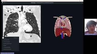 Tomografía de tóraxRadiant [upl. by Litt]