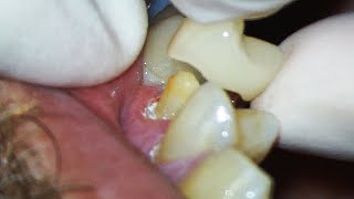 Dental Crown EXPLAINED and how much Tooth Youll Lose [upl. by Gino]