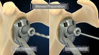 Equinoxe Preserve Stem rTSA Operative Technique Overview [upl. by Juli477]