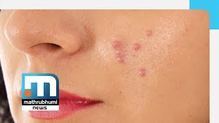 Pimples And Treatment  Doctor2PM Mathrubhumi News [upl. by Notneuq]