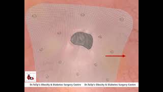 Umbilical Hernia Repair  Animation  Dr Tulips TODS  Animation of Repair of Umbilical hernia [upl. by Eelanaj]