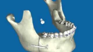 Retroceso de Mandíbula por Prognatismo Mandibular [upl. by Ummersen]