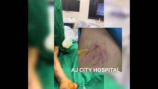 Vericose vein surgery and exercises [upl. by Astiram]