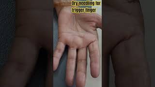 dry needling treatment for trigger finger painrelief cupping dryneedlingtherapy [upl. by Alolomo]