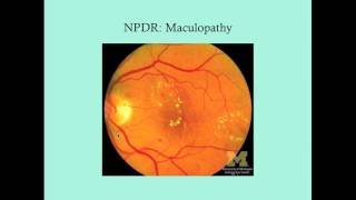 Diabetic Retinopathy  CRASH Medical Review Series [upl. by Aura]