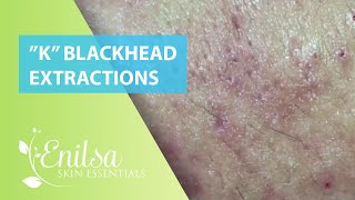 Blackheads Extractions “K’s” 7th Treatment [upl. by Tnert268]