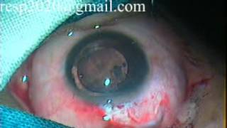 Capsular Tension Ring Insertion CTR in Subluxated Cataract By Dr Sudhir Singh [upl. by Pilihp467]