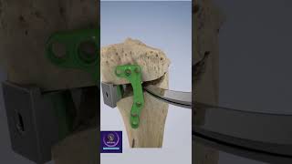 Osteotomy for Osteoarthritis shorts [upl. by Harwill500]