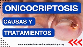 🛑 ONICOCRIPTOSIS sus Causas y Tratamientos 🔍 [upl. by Hctub]