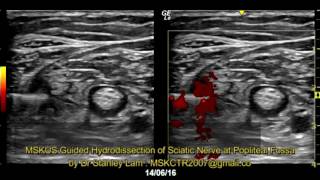 MSKUS Guided Hydrodissection of Sciatic Nerve in Popliteal Fossa [upl. by Etnuhs]