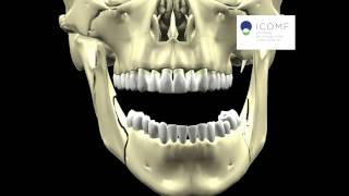 ASIMETRIA MANDIBULAR CIRUGIA MONOMAXILAR [upl. by Javier]