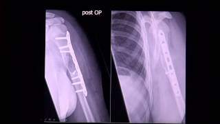 Simple or juvenile bone cyst in MRI scan by RadiologieTV [upl. by Oilcareh]