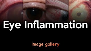 Eye Inflammation Image Gallery [upl. by Eninaj558]