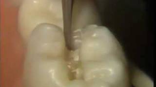 The Amalgam Proximal Box Cavity Preparation [upl. by Isabelita]