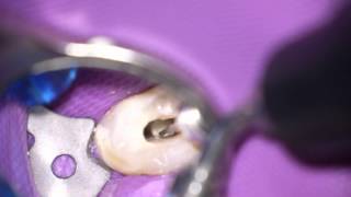 Ultraschall in der Endodontie [upl. by Candy718]