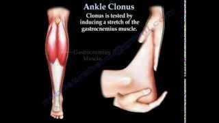 Ankle Clonus  Everything You Need To Know  Dr Nabil Ebraheim [upl. by Shenan]