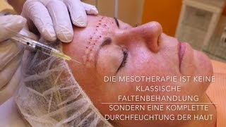 Mesotherapie mit Hyaluronsäure  Behandlung Vorher Nachher [upl. by Juline]