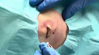 Cyst Incision amp Drainage [upl. by Cavallaro]