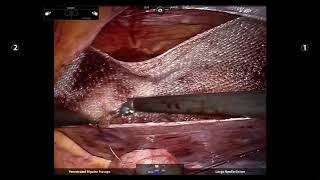 Robotic right inguinal hernia TAPP repair technique with voice over Dr Vikas Singhal [upl. by Vevina]