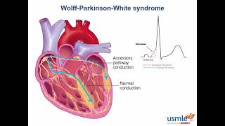 WPW syndrome CVS [upl. by Ettezus385]