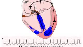 ECG Bài 33 AVRT Điện Tim Điện Tâm Đồ [upl. by Dammahom]