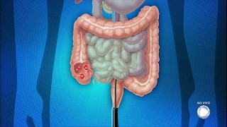 Você e o Doutor saiba tudo sobre os males do intestino [upl. by Scheld]