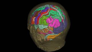 Cavernoma parietal [upl. by Etteragram]