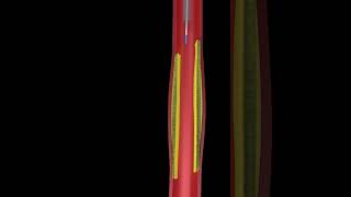 Learn How Angioplasty Works Animated Video [upl. by Bramwell]