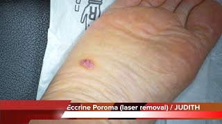 Eccrine Poroma on old age male sole Laser Removal Surgery HD 노인 발바닥 에크린 한공종 레이저 제거 수술  유디트 성형외과 [upl. by Pris209]