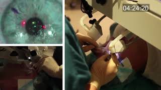 Realtime uncut unedited LASIK procedure live with real sound [upl. by Leimad]