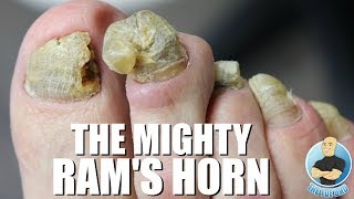 OVERGROWN RAMS HORN TOENAIL REMOVAL [upl. by Bornie870]