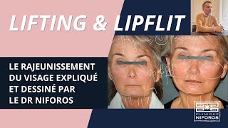 Rajeunissement du visage par lifting et liplift [upl. by Gilda]