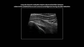 Subacromial impingement on dynamic realtime shoulder ultrasound case 5 [upl. by Aicelav310]