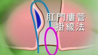 痔瘡廔管中醫掛線療法 自然順勢中醫診所盧旭明中醫師簡介 [upl. by Zachery]