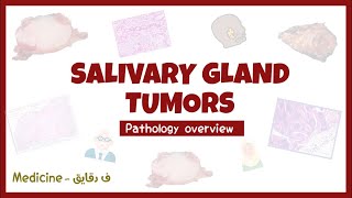 Salivary glands tumors  Pleomorphic adenoma Warthin tumor pathology overview شرح [upl. by Adnaval]