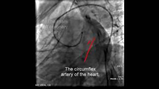 Coronary angiography anatomy [upl. by Oberheim]