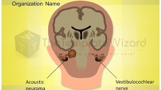 Acoustic Neuroma Vestibulocochlear Nerve Medical PPT Presentation Template by TheTemplateWizardcom [upl. by Segroeg184]