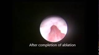 Posterior Urethral Valve Laser Ablation [upl. by Azeel]