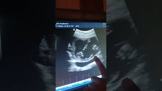 Twin pregnancy How to detect twin pregnancy Two fetus in ultrasound Judwa bachche [upl. by Mahda774]