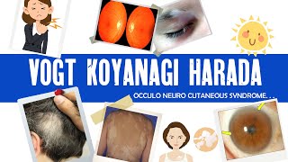 Vogt Koyanagi Harada syndrome  VKH  granulomatous uveitis  ophthalmology [upl. by Poppas]