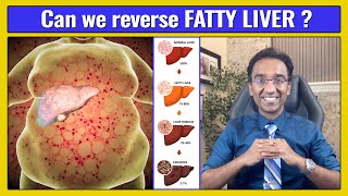 Fatty Liver  Do NOT Ignore  Dr Pal [upl. by Anialeh]