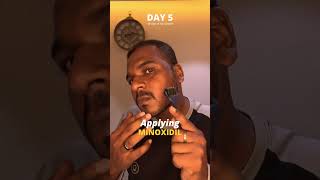 Using Minoxidil daily for Hair Growth  Day 5 minoxidil bald microneedling dermaroller hairloss [upl. by Salesin]