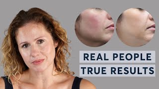 ProfhiloHydro Deluxe  Real People True Results [upl. by Jewel806]