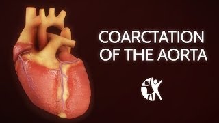 Coarctation of the Aorta [upl. by Karlotte201]